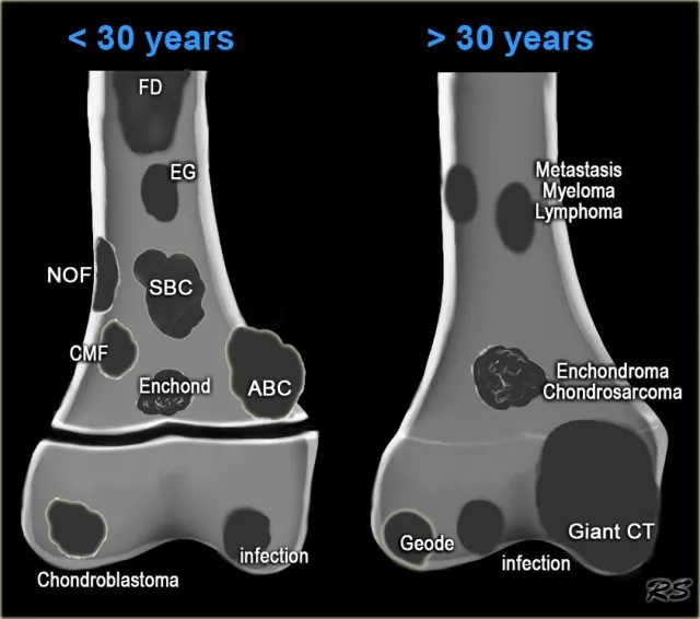 Bone Tumors by Age: Benign vs Malignant