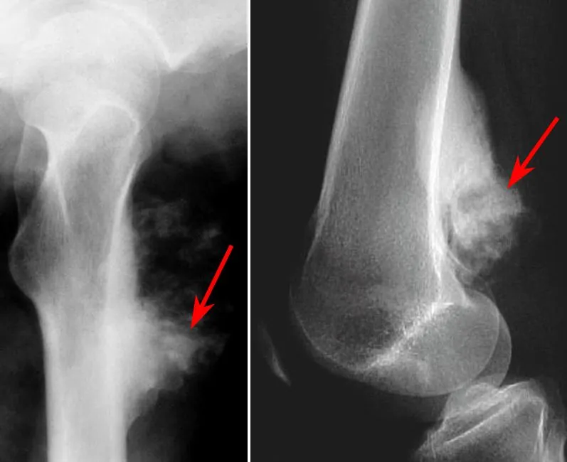 Osteosarcoma X-ray: Sunburst and Codman's triangle