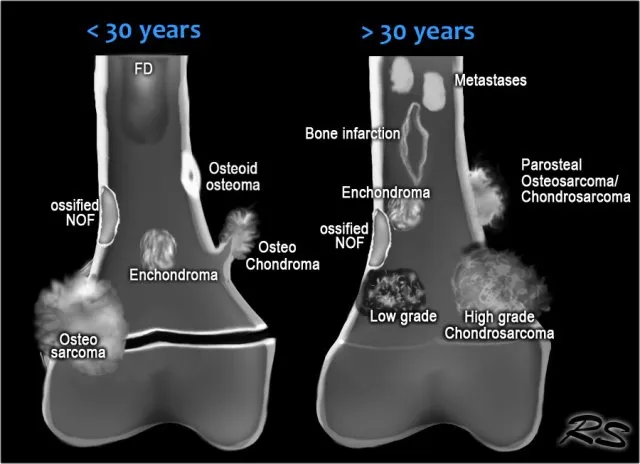 Bone tumors by age: <30 vs >30 years