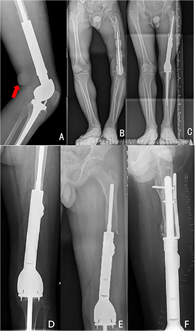 Post-op X-ray with endoprosthesis