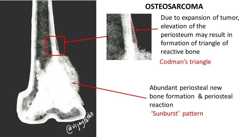 Osteosarcoma X-ray: Sunburst pattern & Codman's triangle