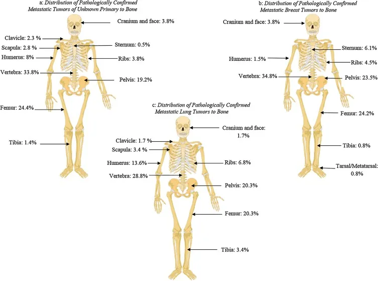 Skeletal distribution of metastatic tumors