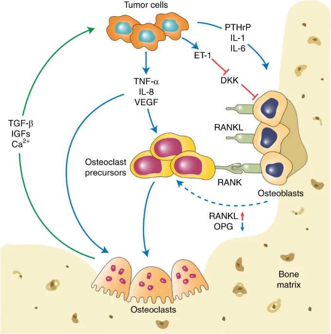 Tumor-bone cell interactions in metastatic bone disease