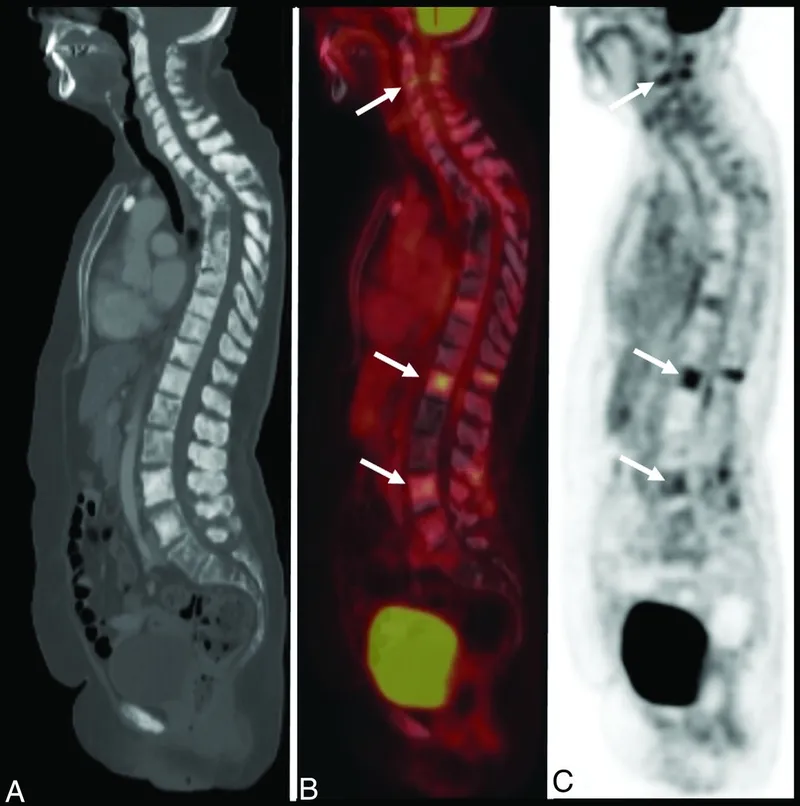 Metastatic Bone Disease: CT, PET-CT, and PET Imaging