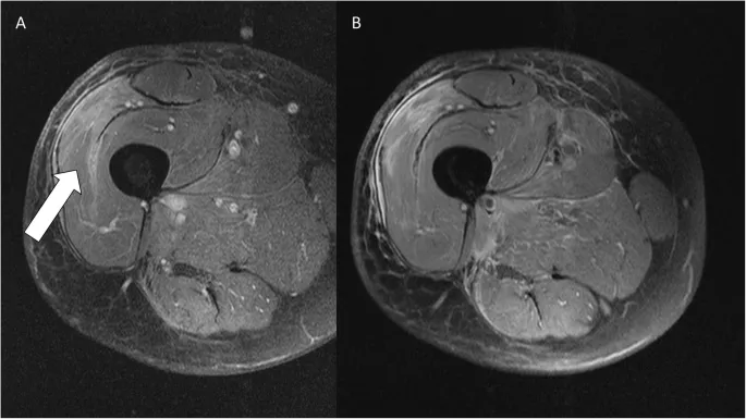 MRI axial view of thigh soft tissue sarcoma with contrast