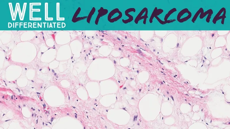 Histopathology of Well-Differentiated Liposarcoma