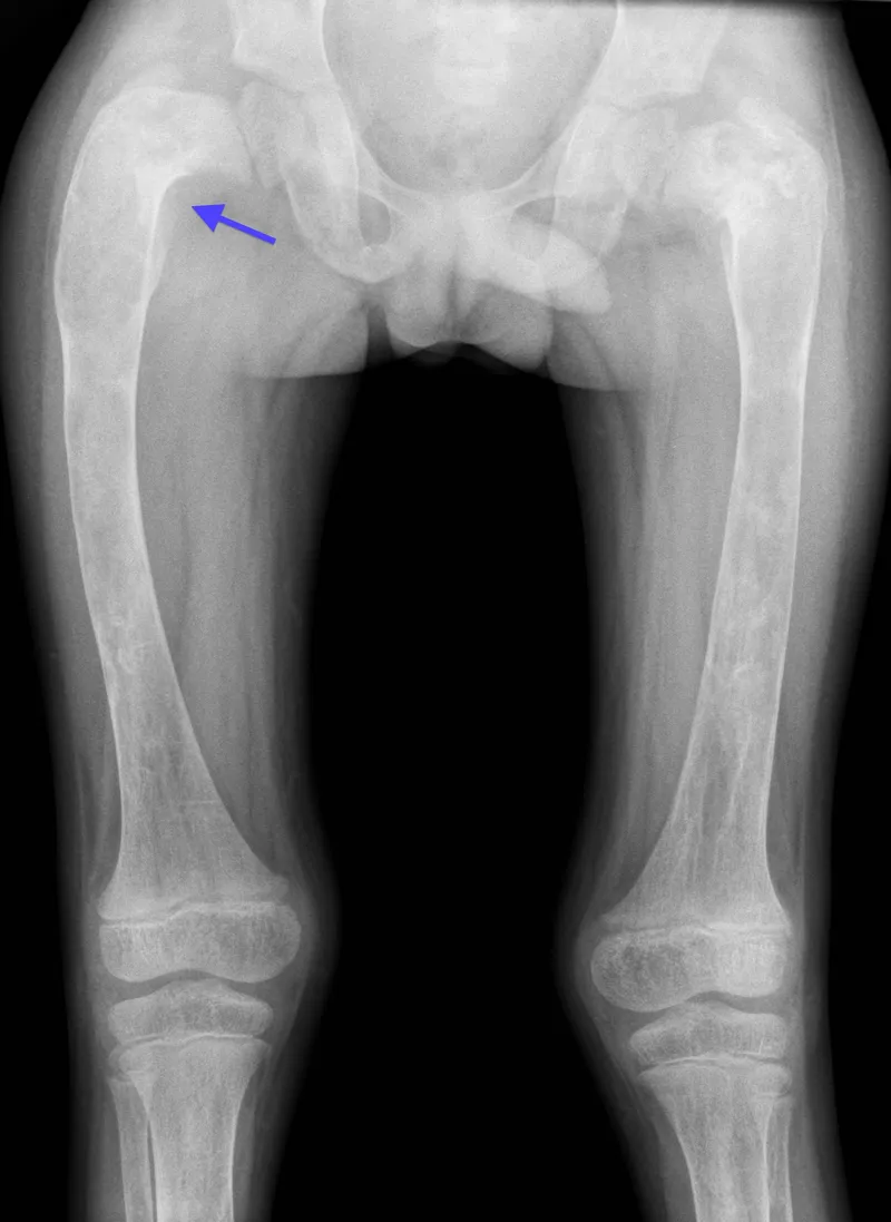 Fibrous dysplasia with shepherd's crook deformity
