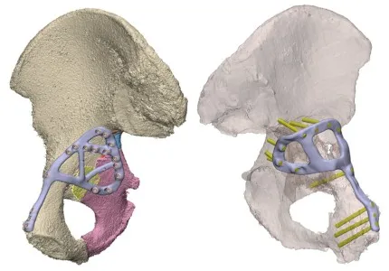 3D printed custom orthopaedic implant for pelvis