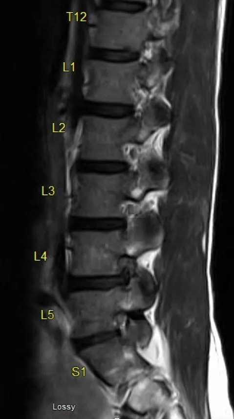 Sagittal MRI Lumbar Spine Degenerative Disc Disease