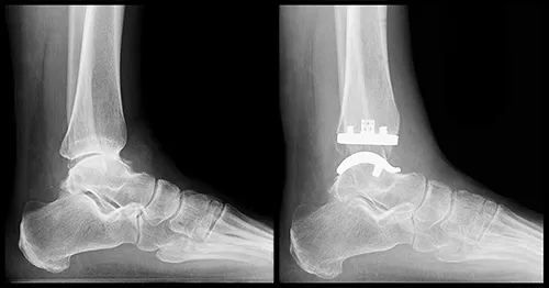Ankle X-ray: Osteoarthritis vs Total Ankle Arthroplasty