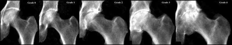 Kellgren-Lawrence grades of hip osteoarthritis