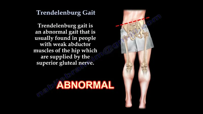 Trendelenburg Gait Illustration