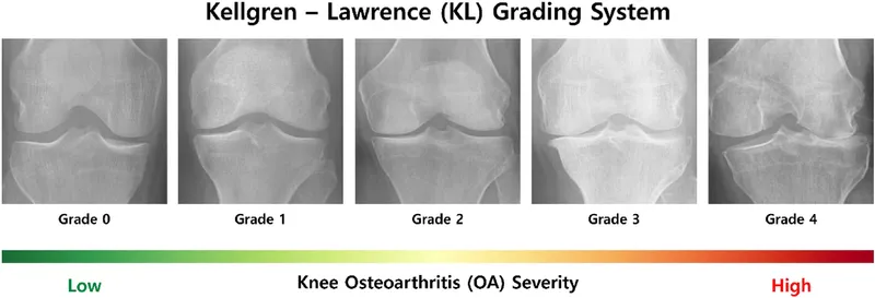 Kellgren-Lawrence Grading of Knee Osteoarthritis