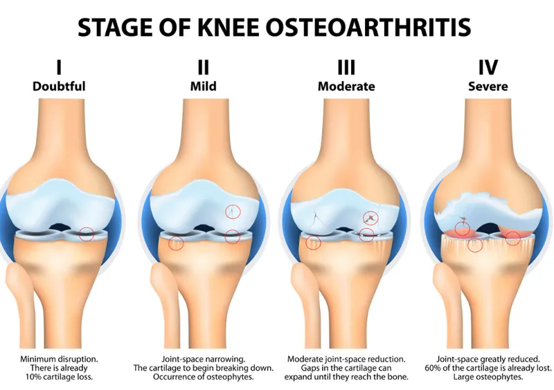 Stages of Knee Osteoarthritis