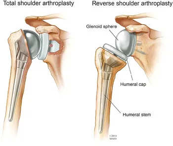 Total vs. Reverse Shoulder Arthroplasty Implants