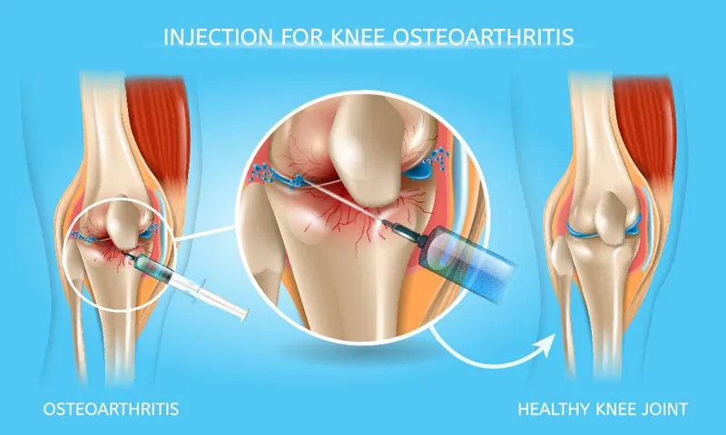 Intra-articular injection for knee osteoarthritis