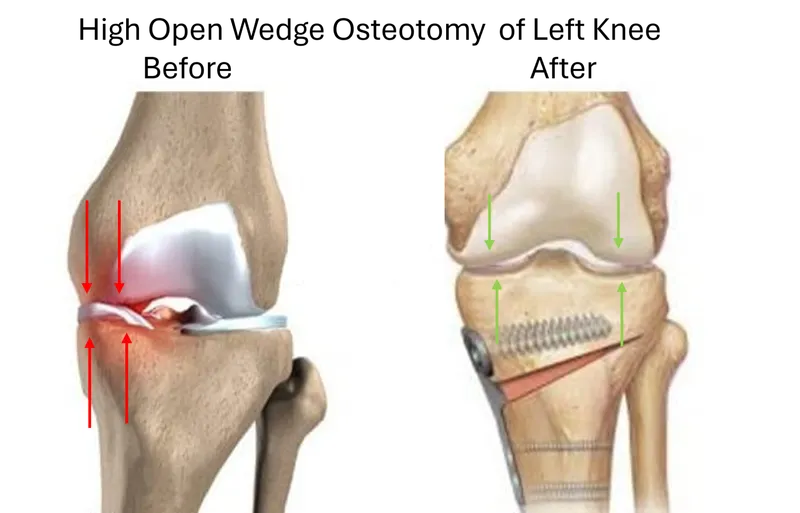 HTO vs Osteoarthritis