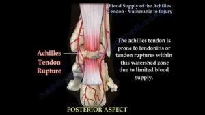 Achilles Tendon Blood Supply and Rupture Risk