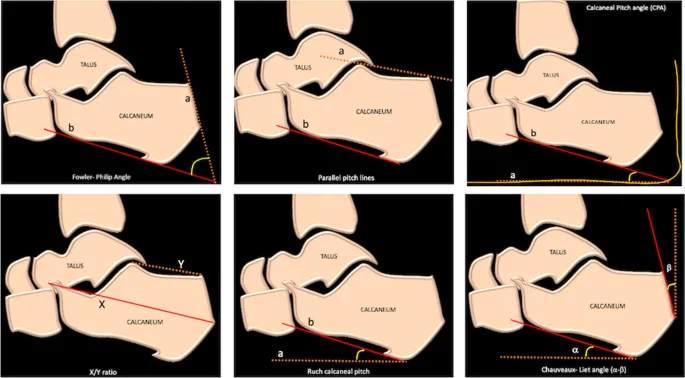 Calcaneal angle measurements for Haglund's deformity
