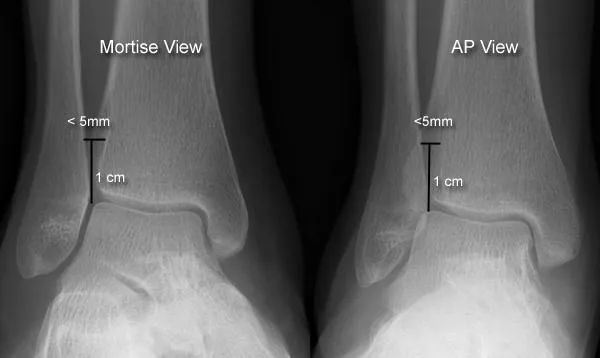 Mortise and AP ankle X-ray views with measurements