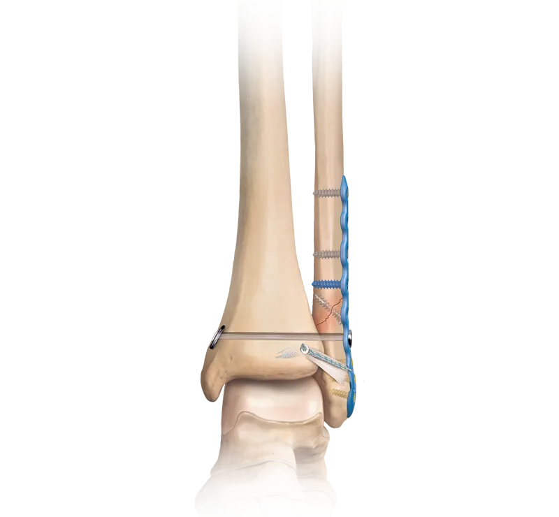 ORIF bimalleolar ankle fracture with syndesmotic fixation
