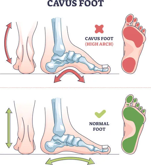 Cavus vs Normal Foot Comparison