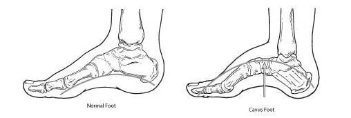 Normal vs. Cavus Foot Anatomy