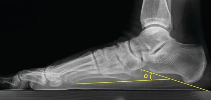 Calcaneal Pitch Angle on Lateral Foot X-ray