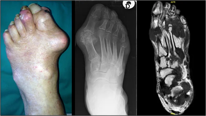 Foot and ankle arthritis: clinical signs, X-ray, and MRI