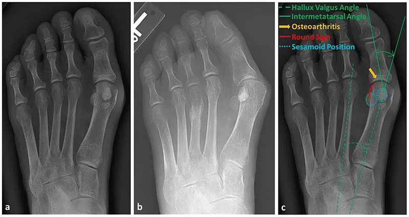 Hallux Valgus Anatomy with Angles