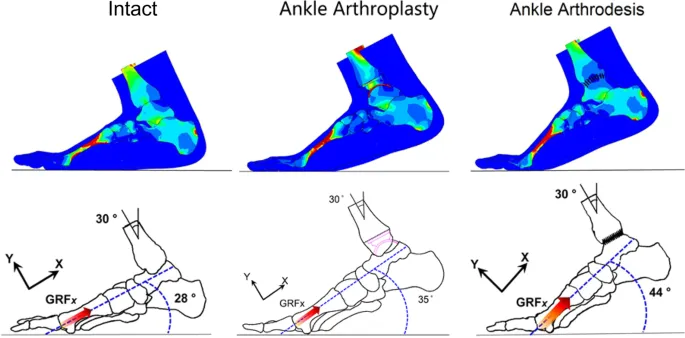Ankle Arthroplasty vs Arthrodesis Biomechanics