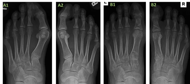 Hallux Valgus Pre- and Post-Op X-rays
