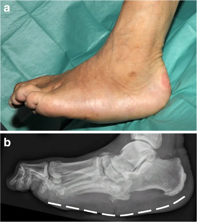 Rocker-bottom deformity clinical photo and radiograph