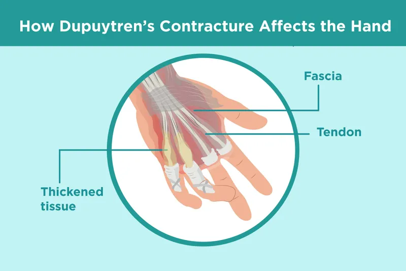 Dupuytren's Contracture Affects the Hand
