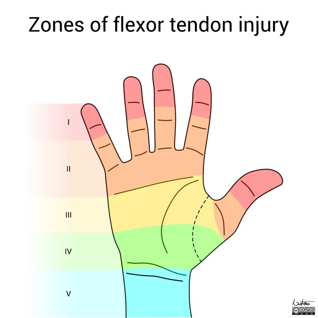 Verdan's flexor tendon zones of the hand