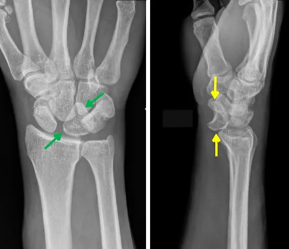 X-ray of lunate dislocation and scaphoid fracture