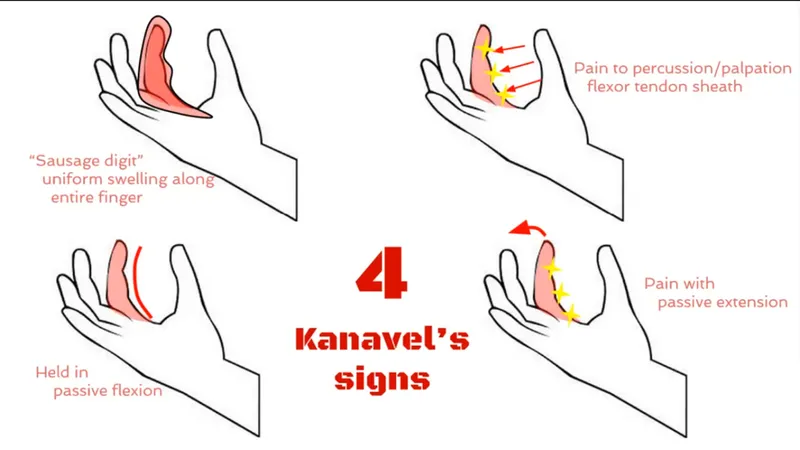 Kanavel's signs of flexor tenosynovitis diagram