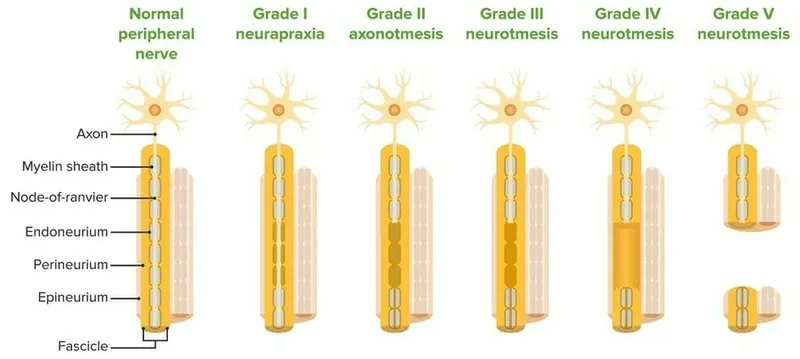 Seddon-Sunderland Nerve Injury Classification