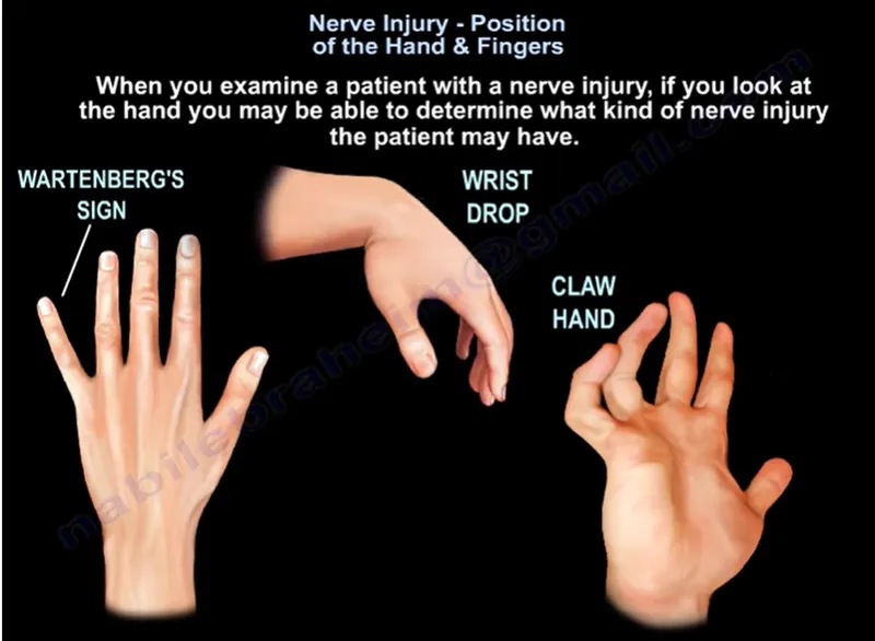 Nerve Injury Signs: Wartenberg's, Wrist Drop, Claw Hand