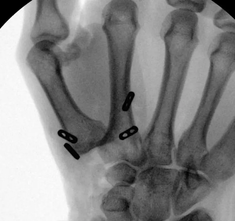 MCP arthroplasty X-ray with implants