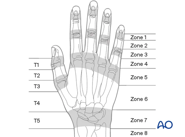 Extensor tendon zones of hand