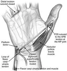 Tendon transfer for thumb opposition