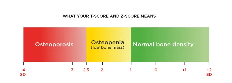 T-score and Z-score interpretation for bone density