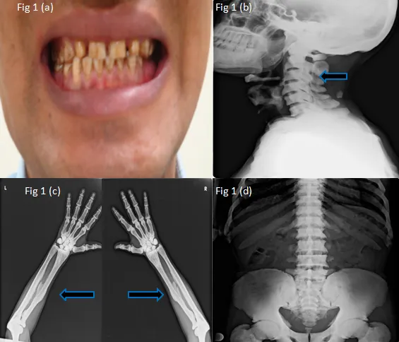Skeletal fluorosis X-rays and dental fluorosis