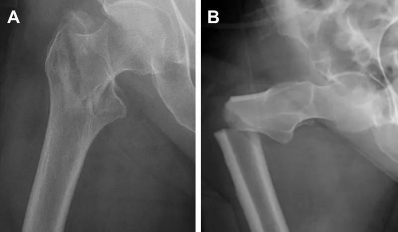 X-ray of hip fragility fracture (A) and normal hip (B)