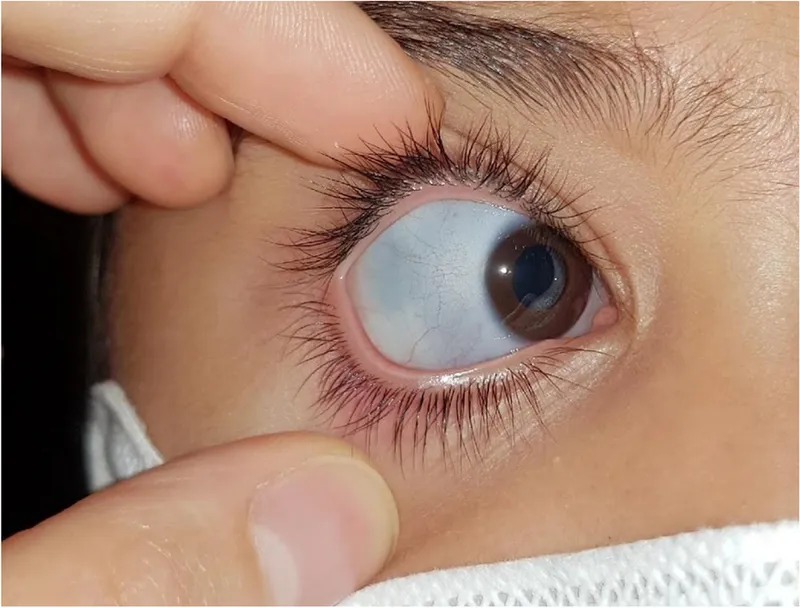 Blue sclerae in Osteogenesis Imperfecta