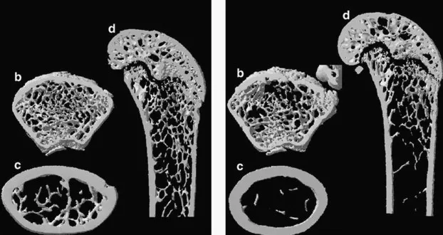 Normal vs Osteoporotic Bone Microstructure