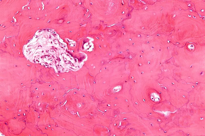 Paget's disease bone histology: mosaic pattern