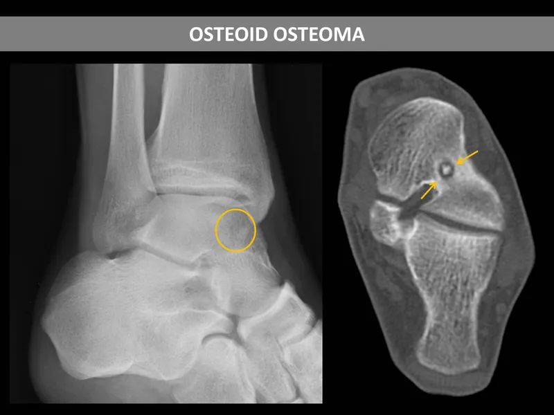 Osteoid Osteoma X-ray and CT