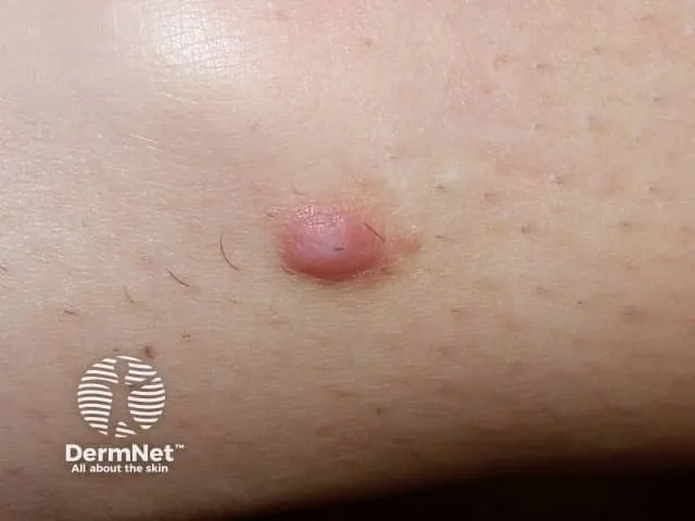 Dermatofibroma with Fitzpatrick sign